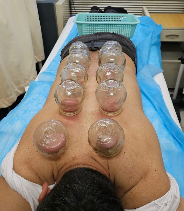 بادکش درمانی