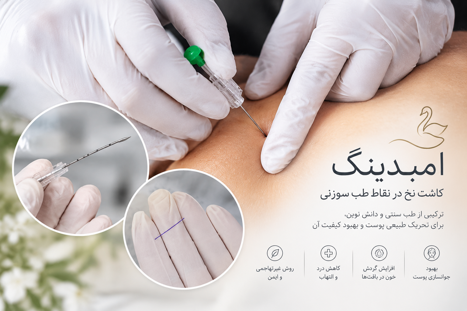 کاشت نخ امبدینگ